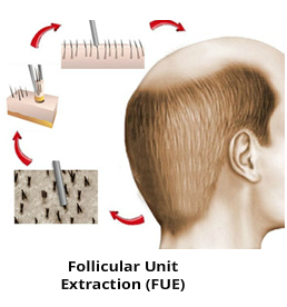 FUE hair transplant surgery London, UK