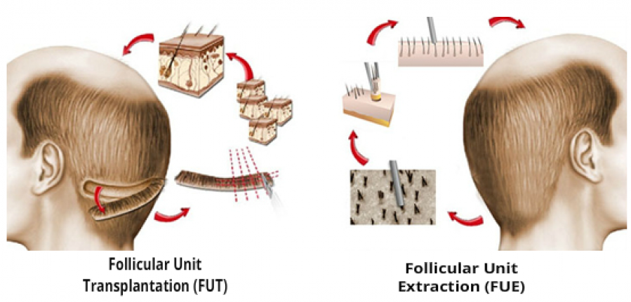 FUE vs FUR hair transplant