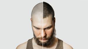 Hair Implants For Men - Male Pattern Baldness, Receding Hairline 