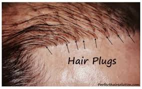 What are hair plugs?